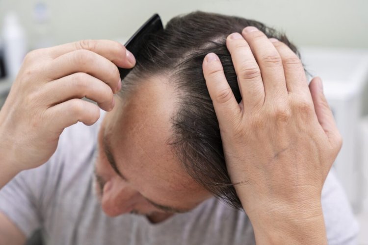 Male Hair Loss Seattle: Effective Treatments for Hair Restoration in Seattle