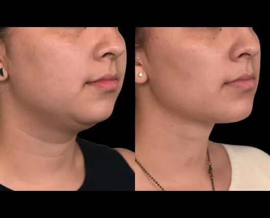 The Best Time of Year to Get Double Chin Removal in Dubai