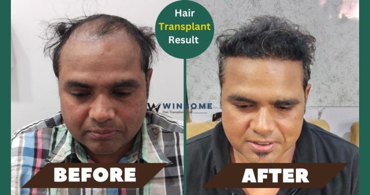 The Facts You Need to Know About Male Hair Transplants