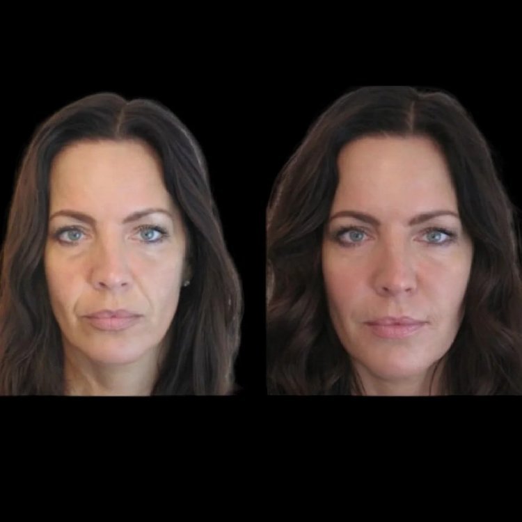 Jawline Fillers Treatments in Dubai: A Non-Surgical Approach to Facial Contouring