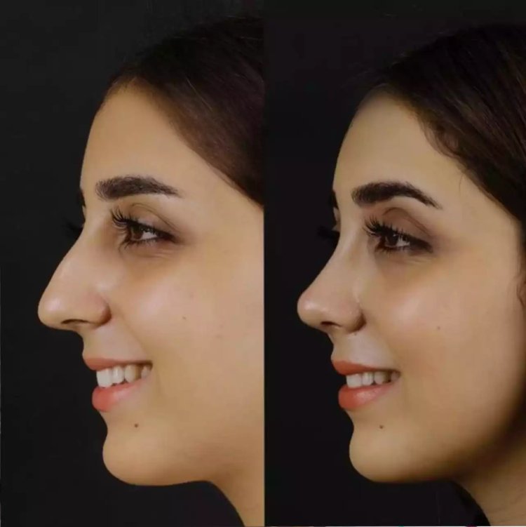 How Long Is the Recovery After Nose Deviated Septum Surgery in Dubai?