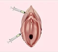 O-Shot Injection: Does It Really Work or Just a Hype?