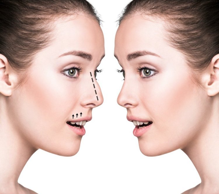 Non-Surgical Rhinoplasty in Dubai: Achieve the Perfect Nose Without Surgery